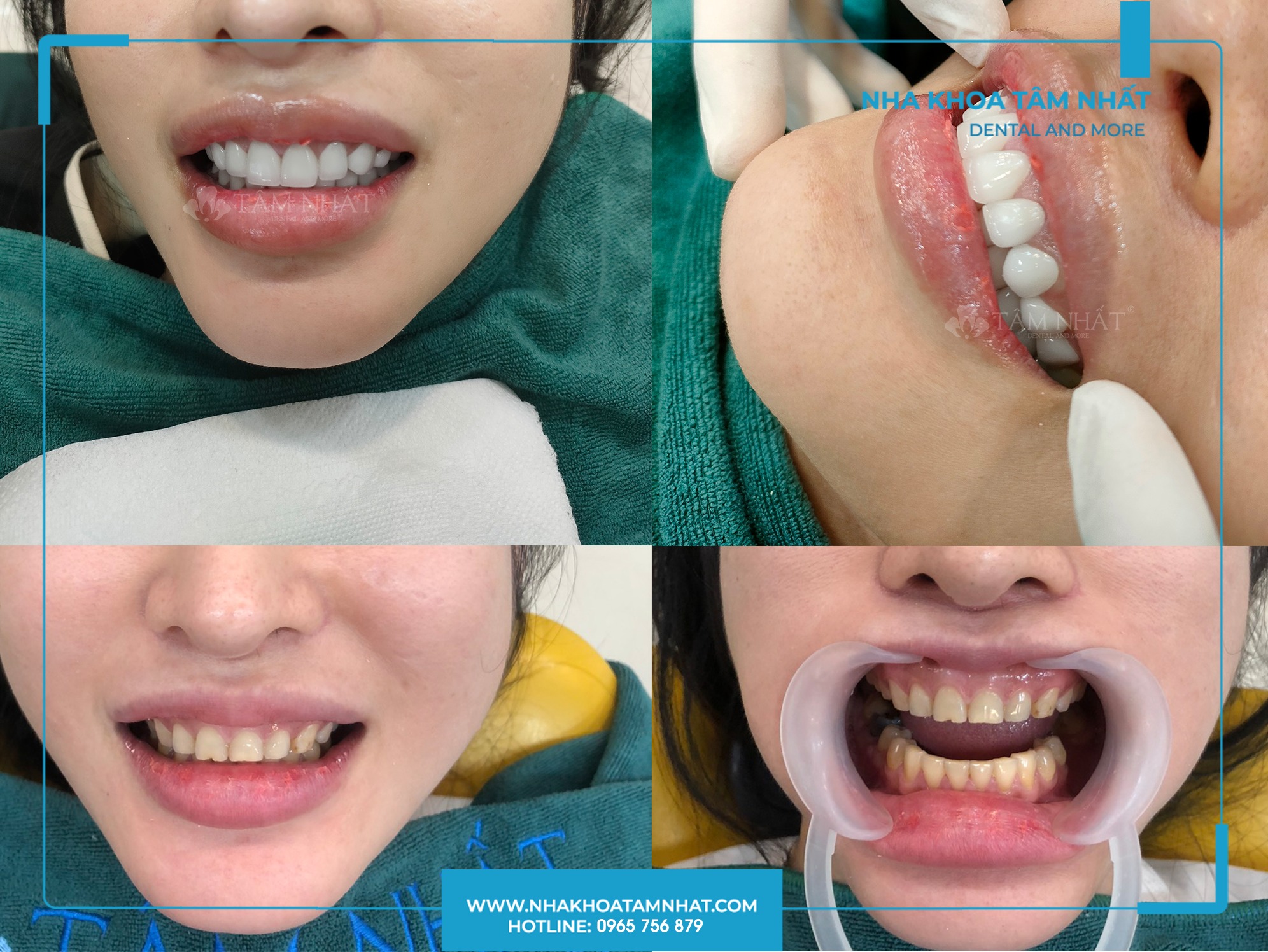 Phương pháp bọc răng sứ có nhiều ưu điểm vượt trội