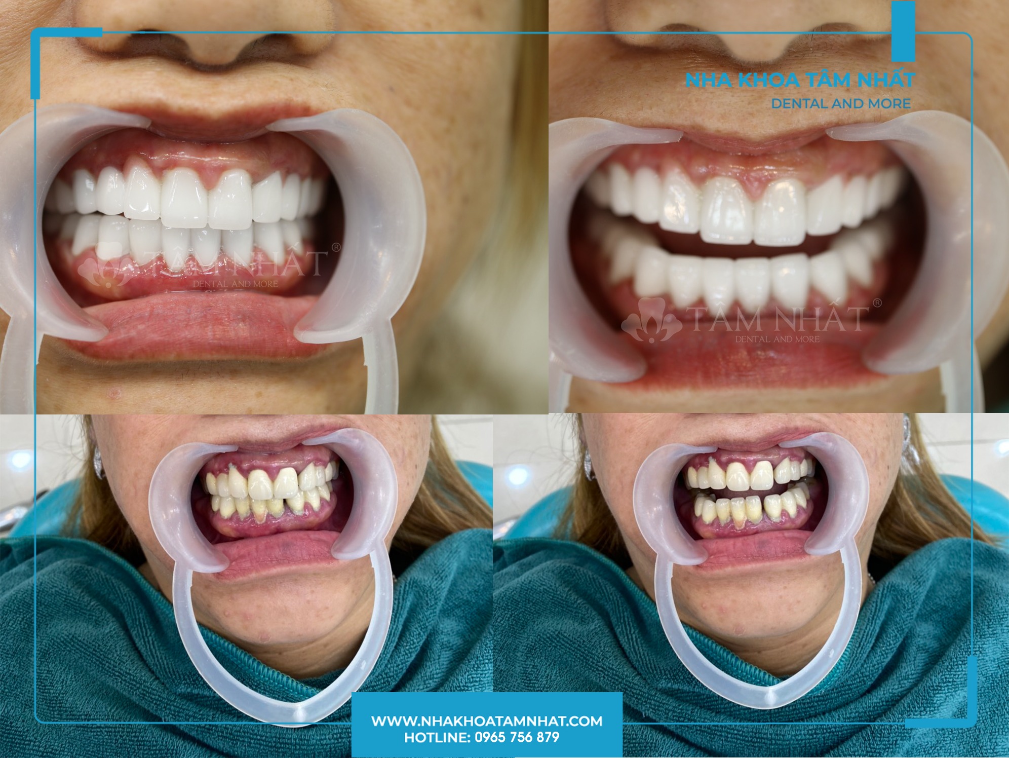 chi phí để làm răng sứ sẽ dao động từ 4.500.000 – 12.500.000 VND/răng