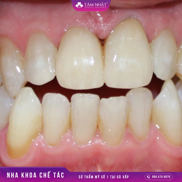 Phương pháp bọc răng sứ có thể giúp khắc được tình trạng răng hô nhẹ