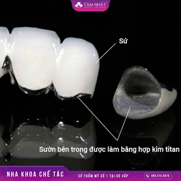 Răng sứ titan có cấu trúc răng giống với răng sứ kim loại