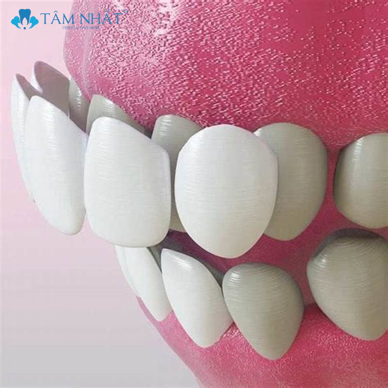 bọc răng sứ thẩm mỹ đang được nhiều người ưu chuộng vì nó mang lại tính thẩm mỹ cao