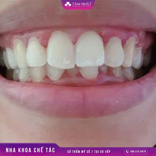 Phương pháp bọc răng sứ có thể khắc phục được những tình trạng răng bị hô nhẹ