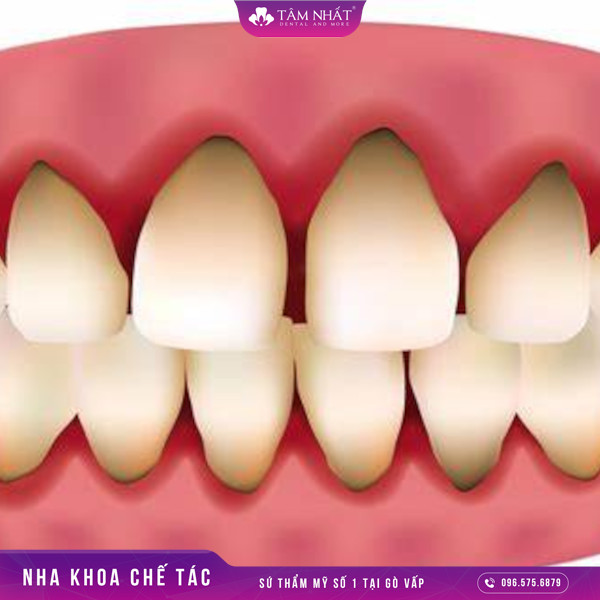 Tiện tượng chân răng mà xuất hiện tình trạng bị đen chủ yếu sẽ xuất hiện ở răng sứ kim loại