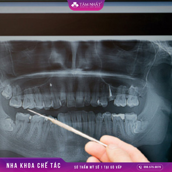 Chụp X-quang để kiểm tra tình hình răng miệng tổng quát
