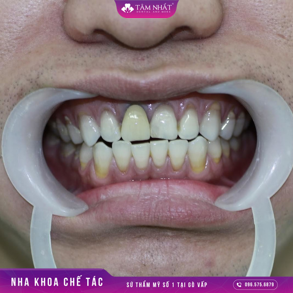 Răng giả bị đổi màu nguyên nhân chính là bạn sử dụng loại răng sứ kim loại