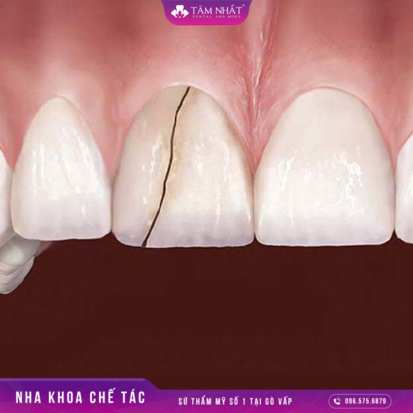 Bọc răng sứ có thể vừa khắc phục được hình dáng của răng bị nứt vỡ