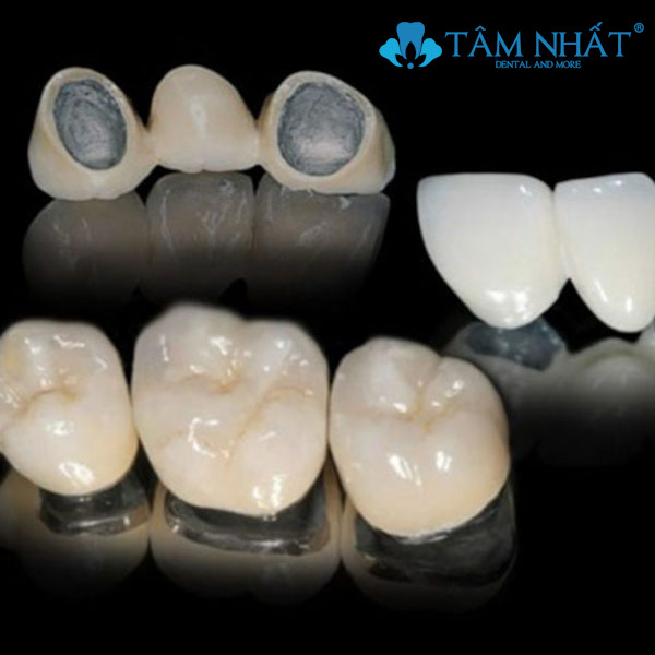 Răng sứ kim loại hiện nay được ít người ưu chuộng bởi nó có chất liệu là kim loại