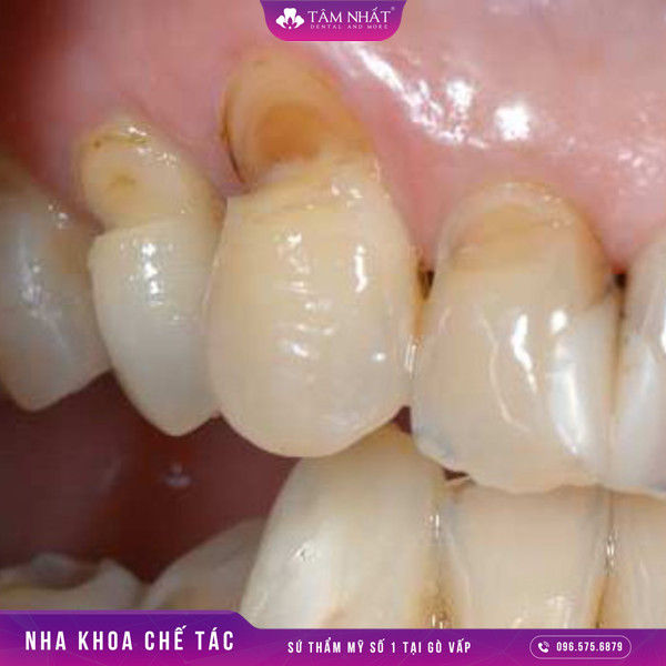 Hở chân răng chính là một bệnh lý thường gặp