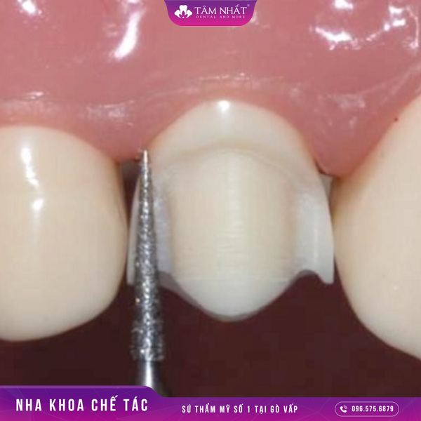 Kỹ thuật bọc răng sứ cần đòi hỏi phải mài ở cả 5 mặt răng để có thể tạo thành trụ răng