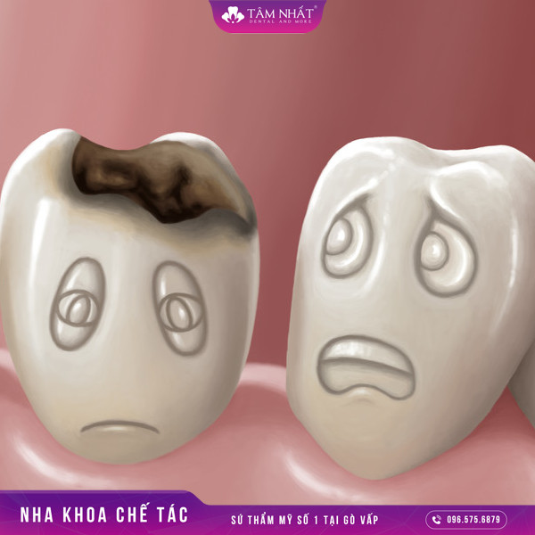 Răng bị sâu hỏng chỉ là tình trạng về răng miệng rất phổ biến