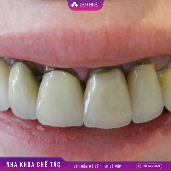Sau khi thực hiện bọc răng sứ bị đen nướu, đen lợi thường khá là phổ biến