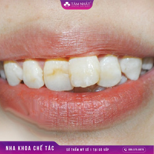 răng mọc lệch là khi răng được mọc không đúng vị trí ở hàm của nó