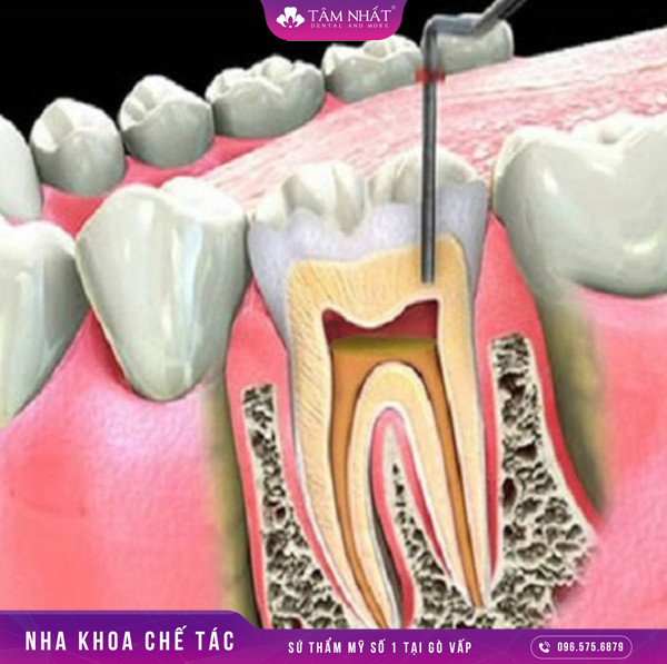 Điều trị tủy răn chưa dứt điểm sẽ khiến ảnh hưởng đến răng sau khi bọc răng sứ