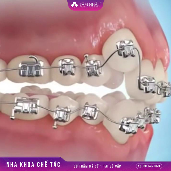 Niềng răng chính là phương pháp chỉnh hình nha khoa không xâm lấn vào răng thật của răng