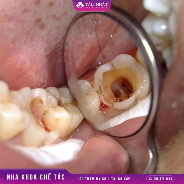răng đã bị lấy tủy thông thường sẽ chỉ duy trì được khoảng 1 năm hoặc là ít hơn