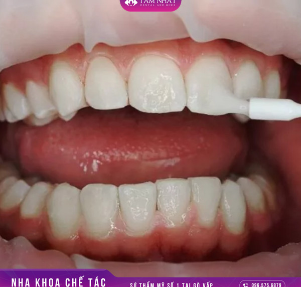 Nồng độ thuốc tẩy trắng răng không được an toàn
