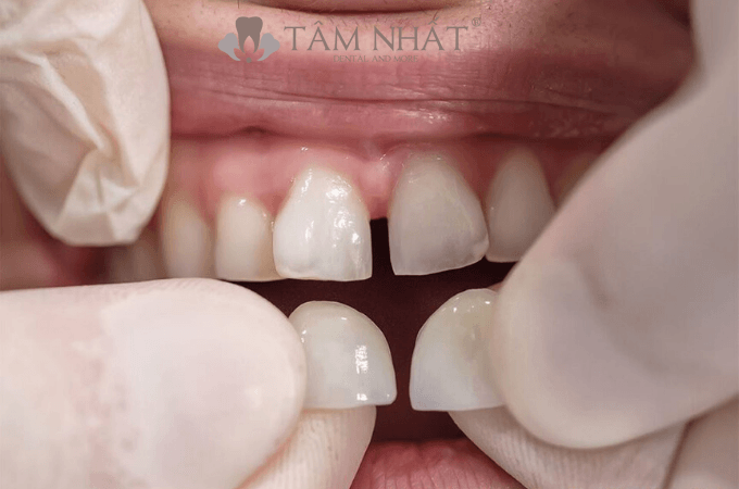việc dán răng sứ có thể giúp thay đổi được hình dáng, màu sắc cũng như kích thước của răng thật